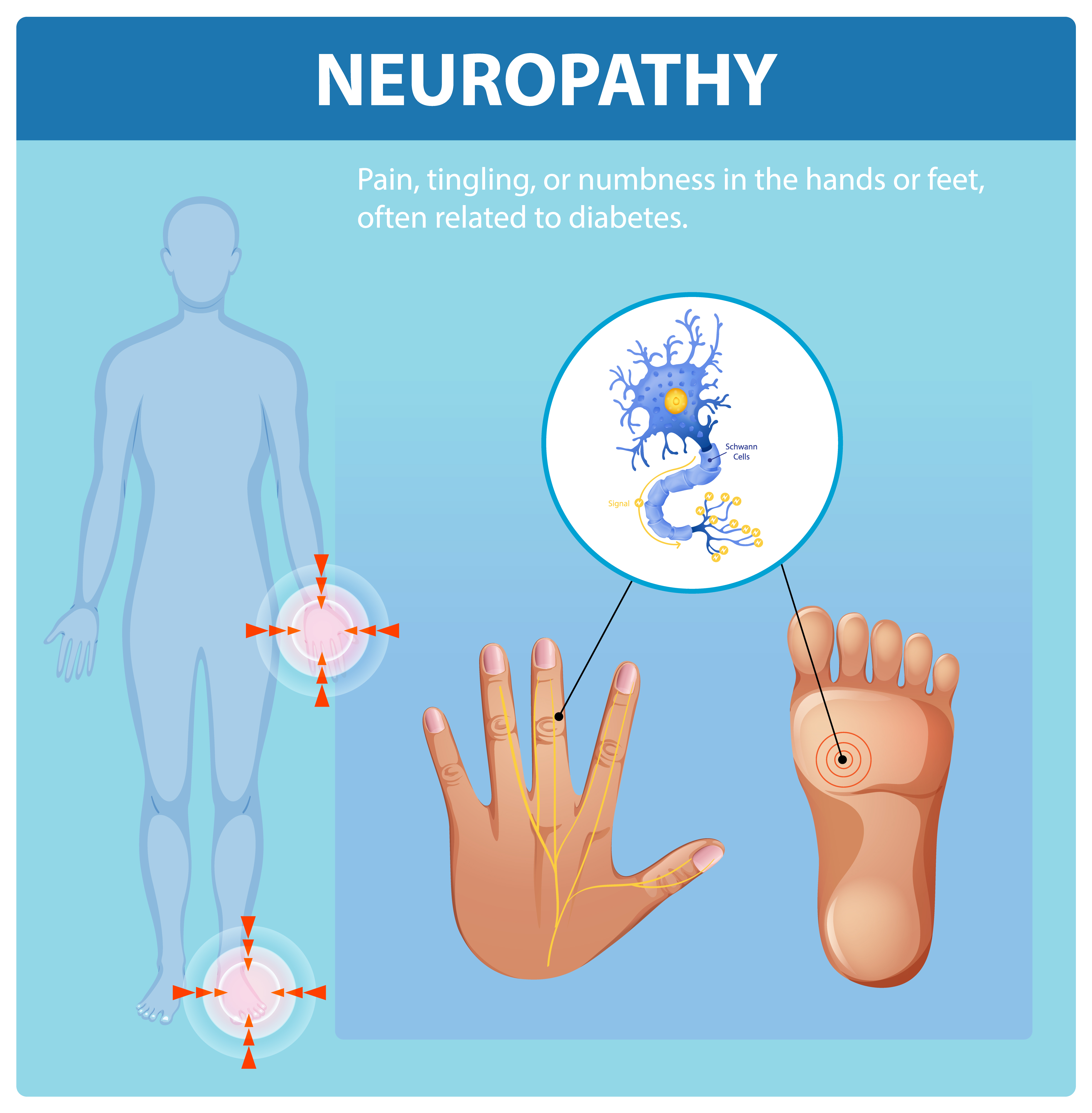 NEUROPATHY